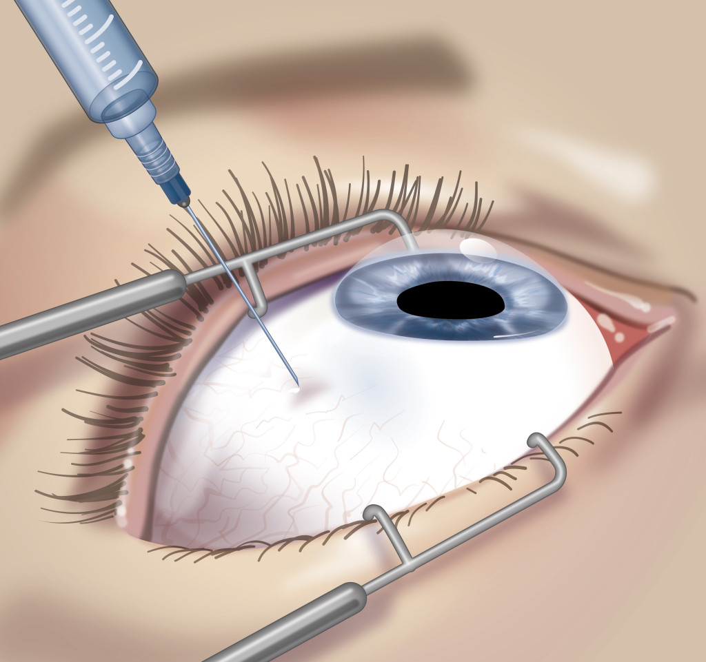 Intravitreale Therapie (Spritzenbehandlung) > Medizinisches Angebot